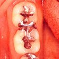 歯の中の象牙質の半分以上まで溶けている状態