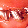 虫歯が象牙質のすべてに及び、歯髄（神経）まで達した状態