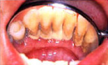 歯周病1