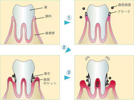 図：歯周病の進行